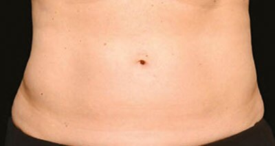 A tummy after body contouring procedure