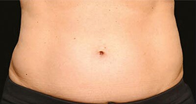 A tummy before body contouring procedure