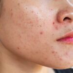 acne on face before treatment